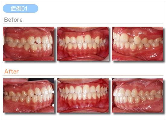 部分矯正治療例