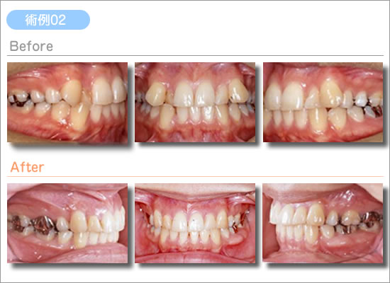 一般矯正治療例